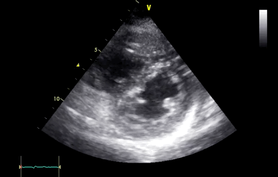 Dilated right ventricle - USabcd