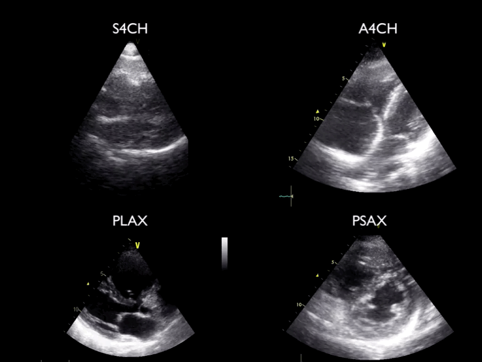Dilated right ventricle - USabcd