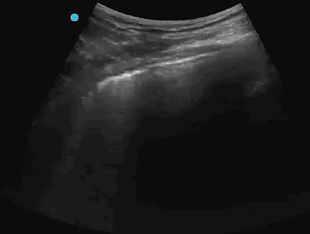 Pneumothorax - USabcd